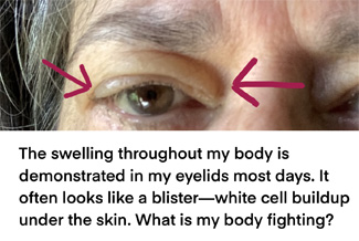 The swelling throughout my body is demonstrated in my eyelids most days. It often looks like a blister—white cell buildup under the skin. What is my body fighting?